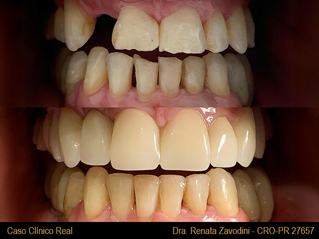 Implante dentário — antes e depois